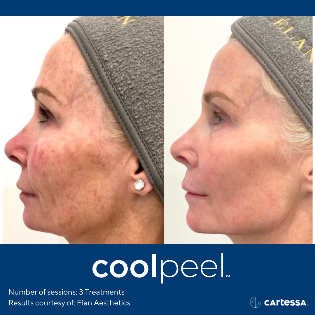 CO2 CoolPeel Laser Treatment in Charleston